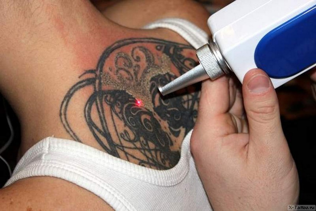 татуировки лазером